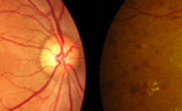 Diabetic Eye Checkup