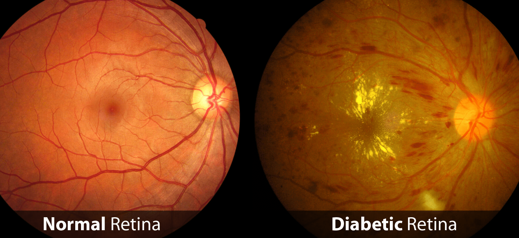 prevent this diabetes complication checked by the Best eye doctor near me
